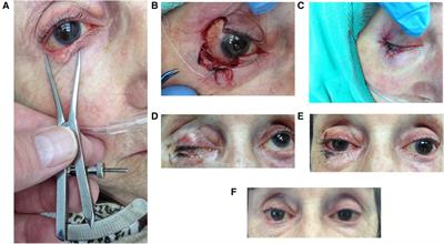 The free bilamellar autograft (FBA) procedure: A comprehensive case series of an alternative surgical approach to reconstruction of large eyelid defects